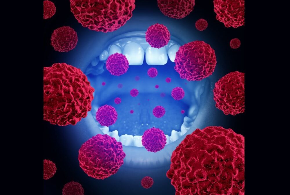 Καρκίνος Στόματος