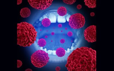 Καρκίνος Στόματος