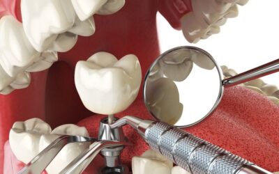 Άμεση Φόρτιση-Δόντια σε 1 Ημέρα