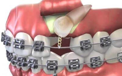 Αποκάλυψη έγκλειστων δοντιών για ορθοδοντικούς λόγους