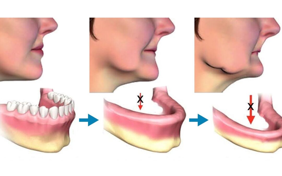 Εμφυτεύματα σε Ατροφική Γνάθο