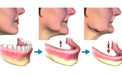 Εμφυτεύματα σε Ατροφική Γνάθο