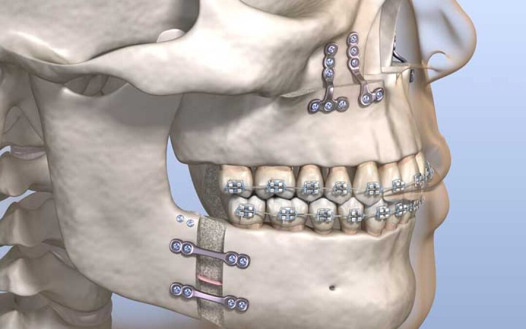 Δυσμορφίες Προσώπου – Ορθογναθική Χειρουργική