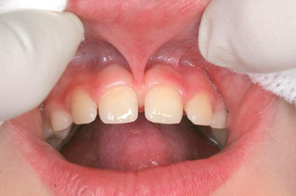 Αφαίρεση χαλινών