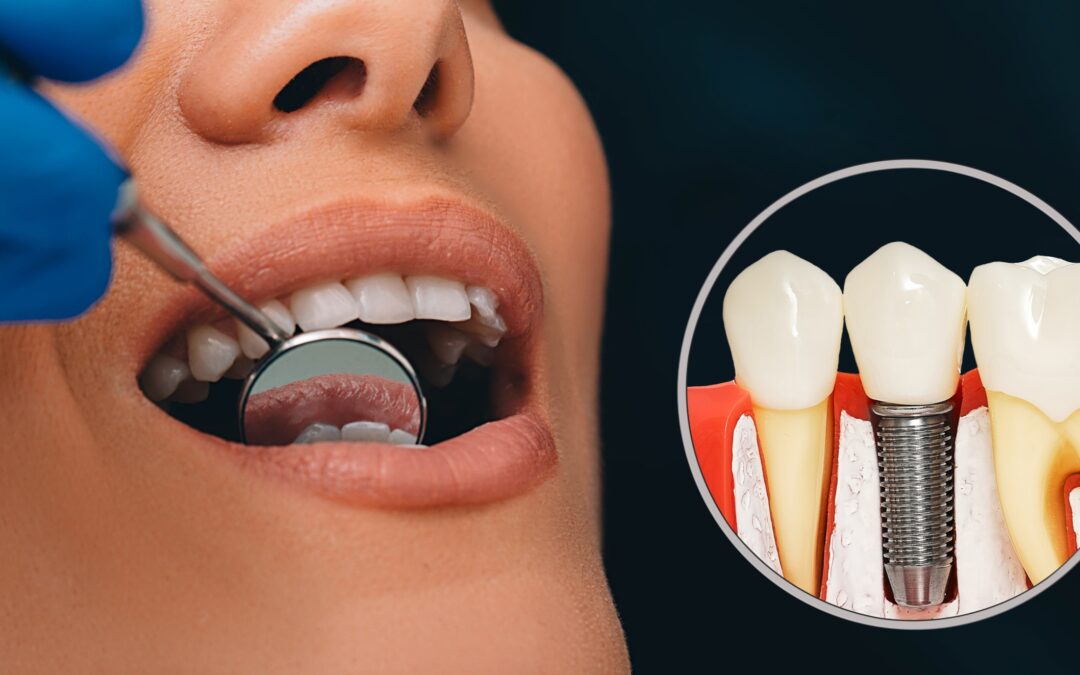 Τι είναι τα Οδοντικά Εμφυτεύματα