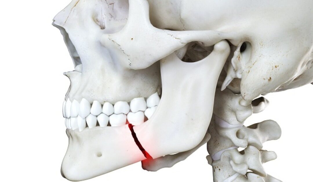 Κατάγματα οστών προσώπου