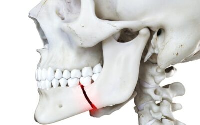 Κατάγματα οστών προσώπου