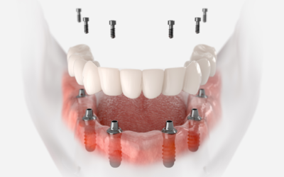 Οστικά μοσχεύματα