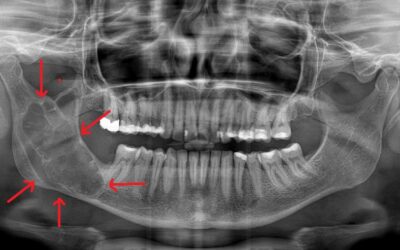 Οδοντογενείς Όγκοι των Γνάθων