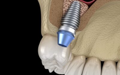 Ανύψωση Ιγμορείου