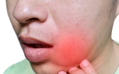 Απόστημα Δοντιού (Οδοντικό): Συμπτώματα, Αίτια και Θεραπεία