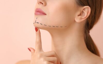 Γενειοπλαστική