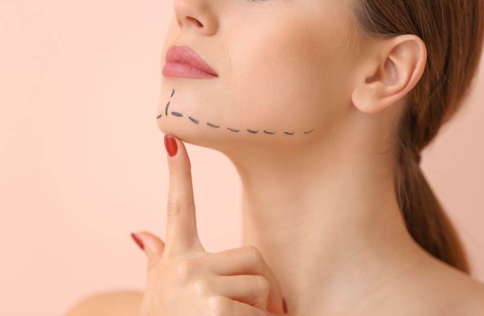 Γενειοπλαστική