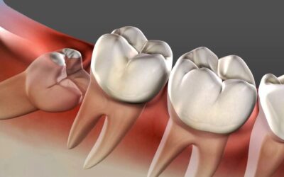 Έγκλειστοι φρονιμίτες