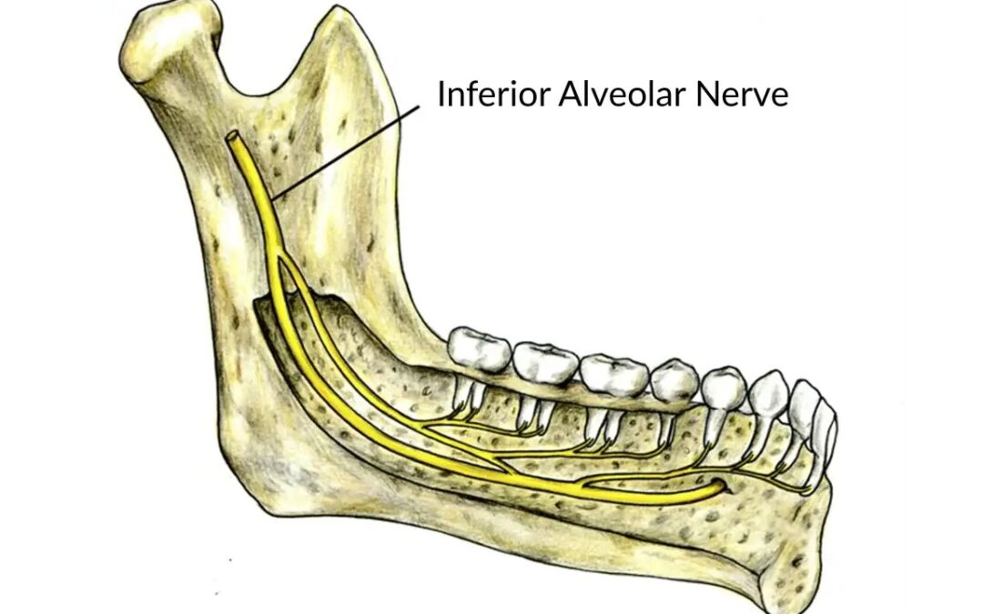 Μετάθεση Κάτω Φατνιακού Νεύρου