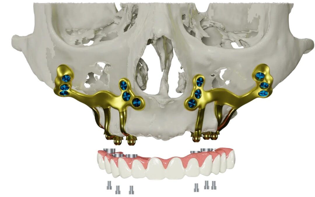 Υποπεριοστικά Εμφυτεύματα: Λύση για Πολύ Λεπτό Οστό χωρίς Μόσχευμα
