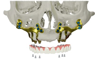 Υποπεριοστικά Εμφυτεύματα: Λύση για Πολύ Λεπτό Οστό χωρίς Μόσχευμα