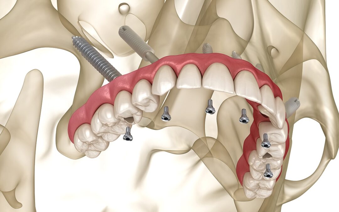 Ζυγωματικά & Πτερυγοειδή Εμφυτεύματα