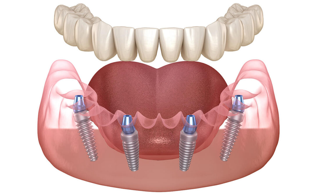 “All-on-4” Εμφυτεύματα