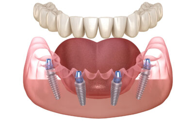 “All-on-4” Εμφυτεύματα