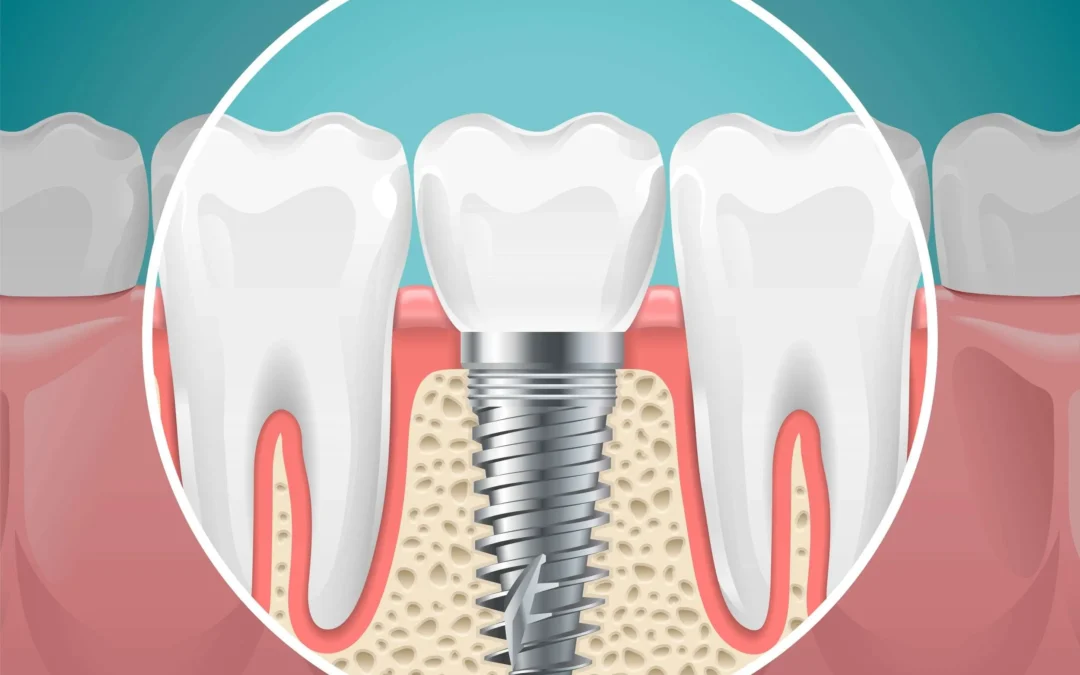 Διάρκεια ζωής των Οδοντικών Εμφυτευμάτων