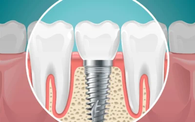 Διάρκεια ζωής των Οδοντικών Εμφυτευμάτων