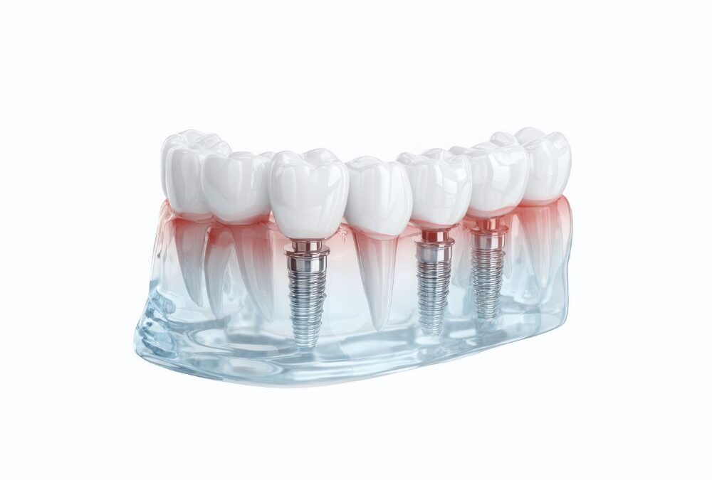 Άμεση Τοποθέτηση Εμφυτευμάτων