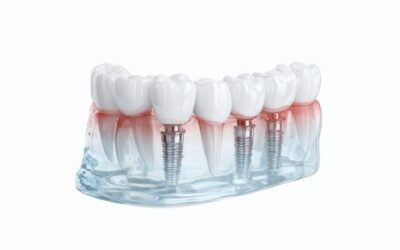 Άμεση Τοποθέτηση Εμφυτευμάτων