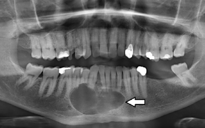 Αδαμαντινοβλάστωμα